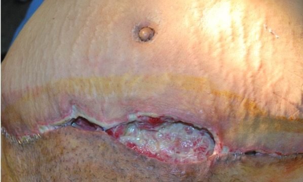 Day 7: wound after minimal debridement
