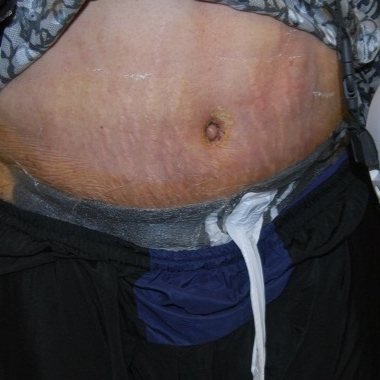 Negative pressure (VAC) therapy in place