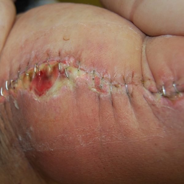 Arm lift wound gaping open along the staple line