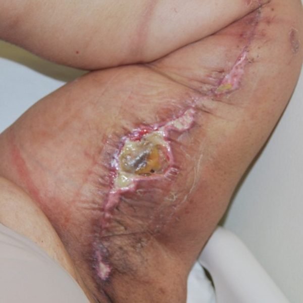 Open arm lift wound with slough near the armpit before debridement