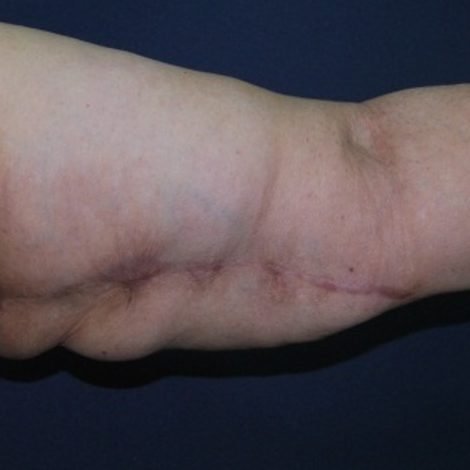 Healed arm lift scar on the inner arm at 4 weeks