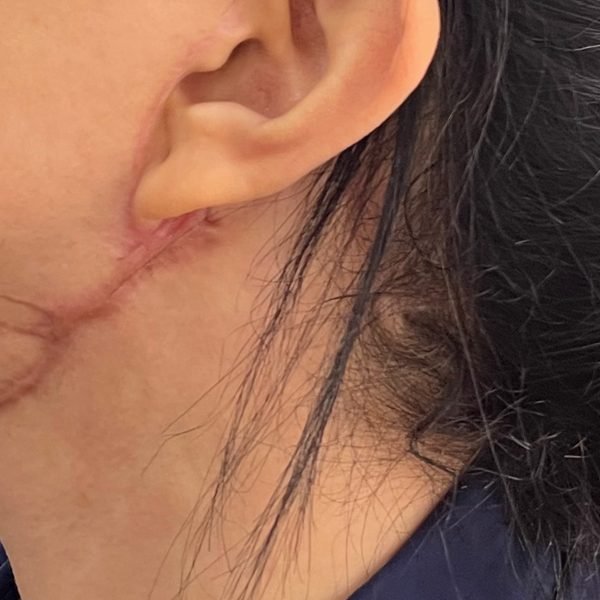Healed scar below the ear, side view