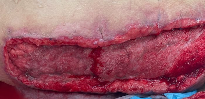Large open thigh wound after necrotising fasciitis following thigh lift