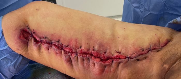 Thigh wound closed with skin advancement and anchoring sutures