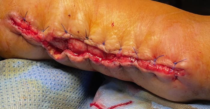 Arm wound closed with skin advancement and anchoring sutures