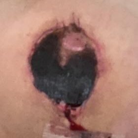 Black necrotic nipple-areola complex after breast reduction