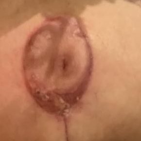 Regenerated nipple-areola complex at 8 weeks
