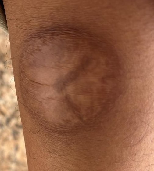 Healed full-thickness cautery burn scar on the shin at 12 weeks