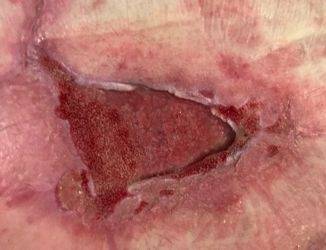 Back wound with healthy granulation tissue after VAC therapy