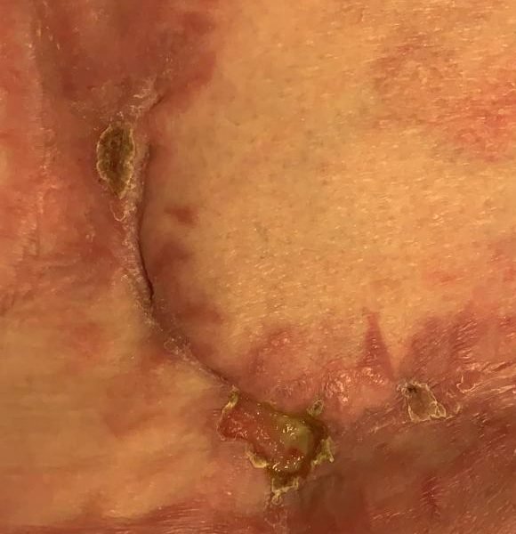 Back wound almost fully healed
